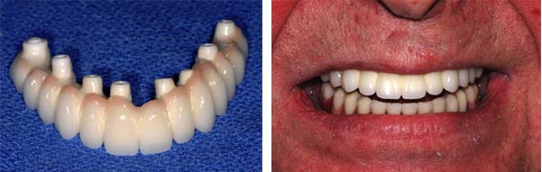 Dental Impalnts