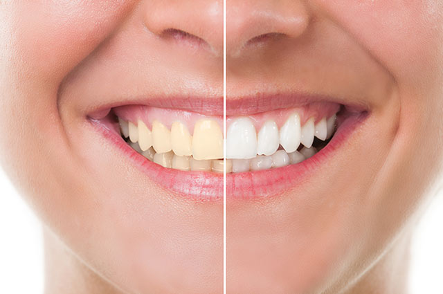 Before and After Teeth Whitening