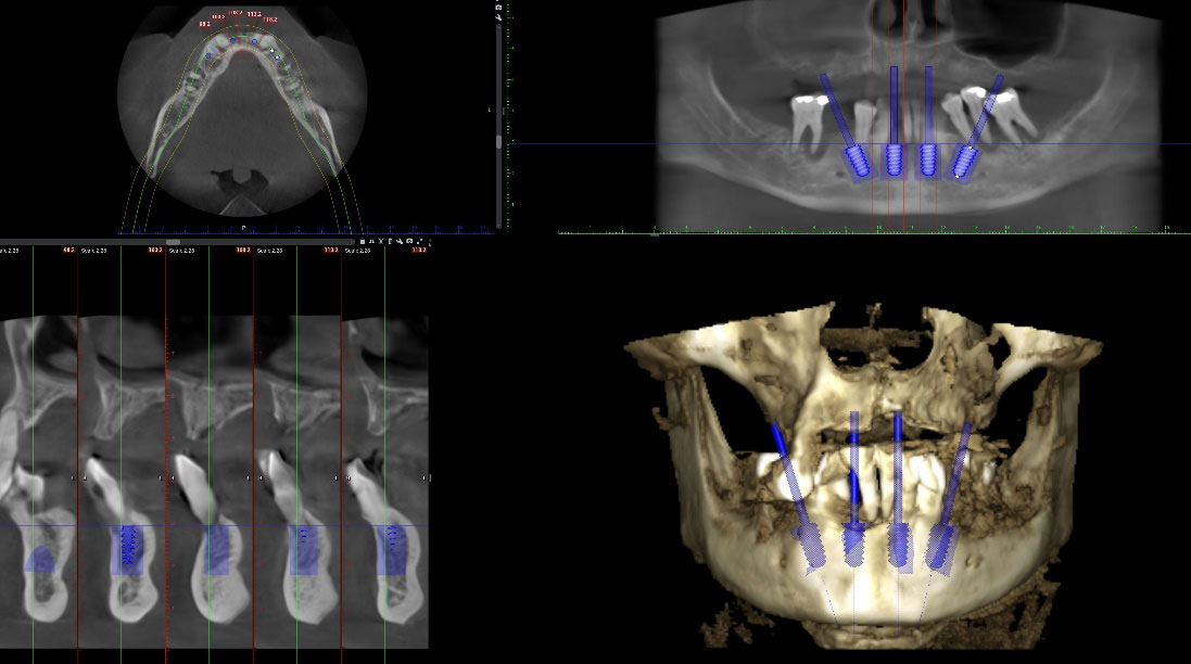 3D Dental Radiographs Planning for Implants