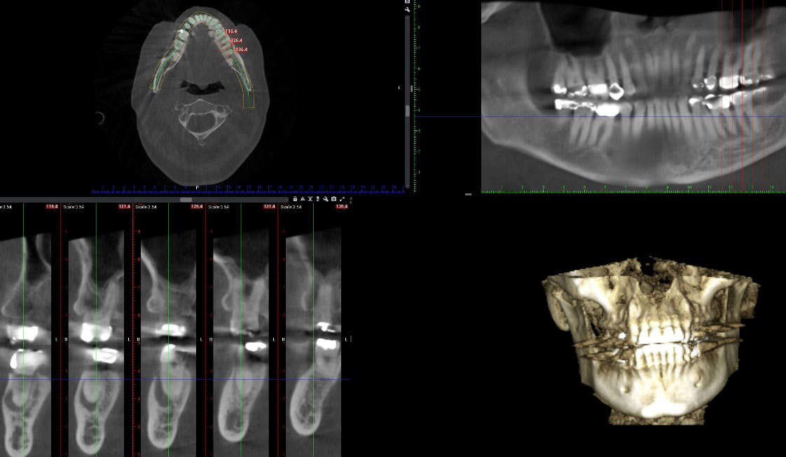 3D Dental Scans - Infection Identified