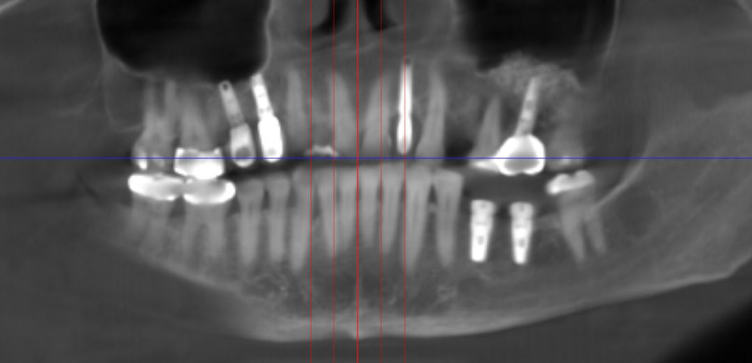 Dental Implants X-Ray