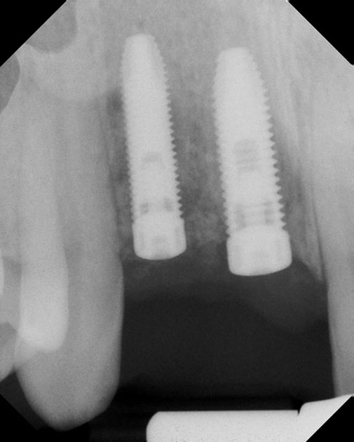 Dental Implant Case 1, X-Ray 1