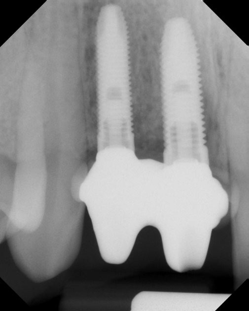 Dental Implant Case 1, X-Ray 2