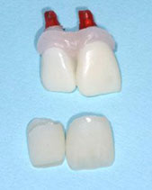 Dental Implant Case 1, photo 4