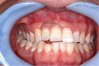 Dental Implant Case 1, photo 5