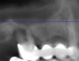 Dental Implant Case 2, X-Ray 1