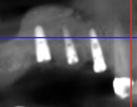 Dental Implant Case 2, X-Ray 2