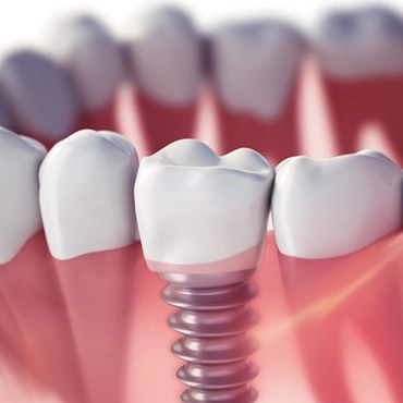 Dental Implants and Periodontal Care