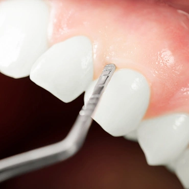 How Gum Disease Is Diagnosed