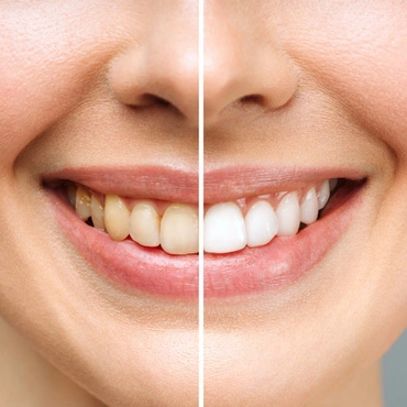Teeth Whitening