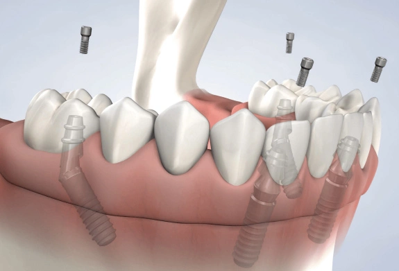 Immediately Loaded Dental Implants