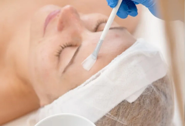 Skin Peels