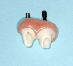 2 Dental Implants Together