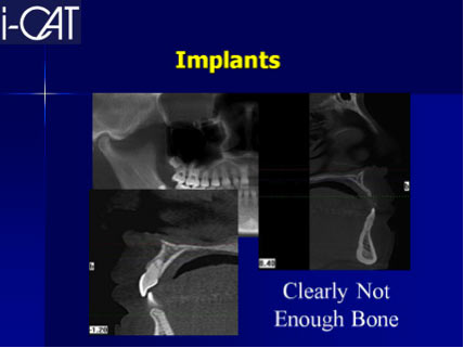 i-Cat Implants