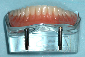 Nylon Implants