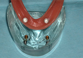 Nylon Dental Implants
