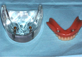 Nylon Dental Implants