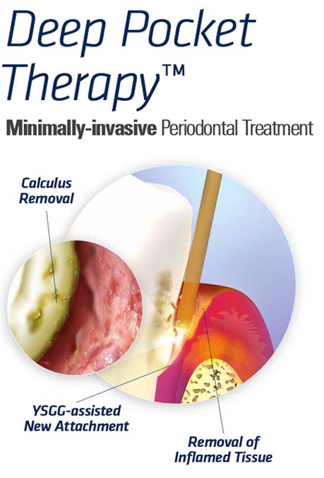 Deep Pocket Therapy - Minimally Invasive Periodontal Treatment
